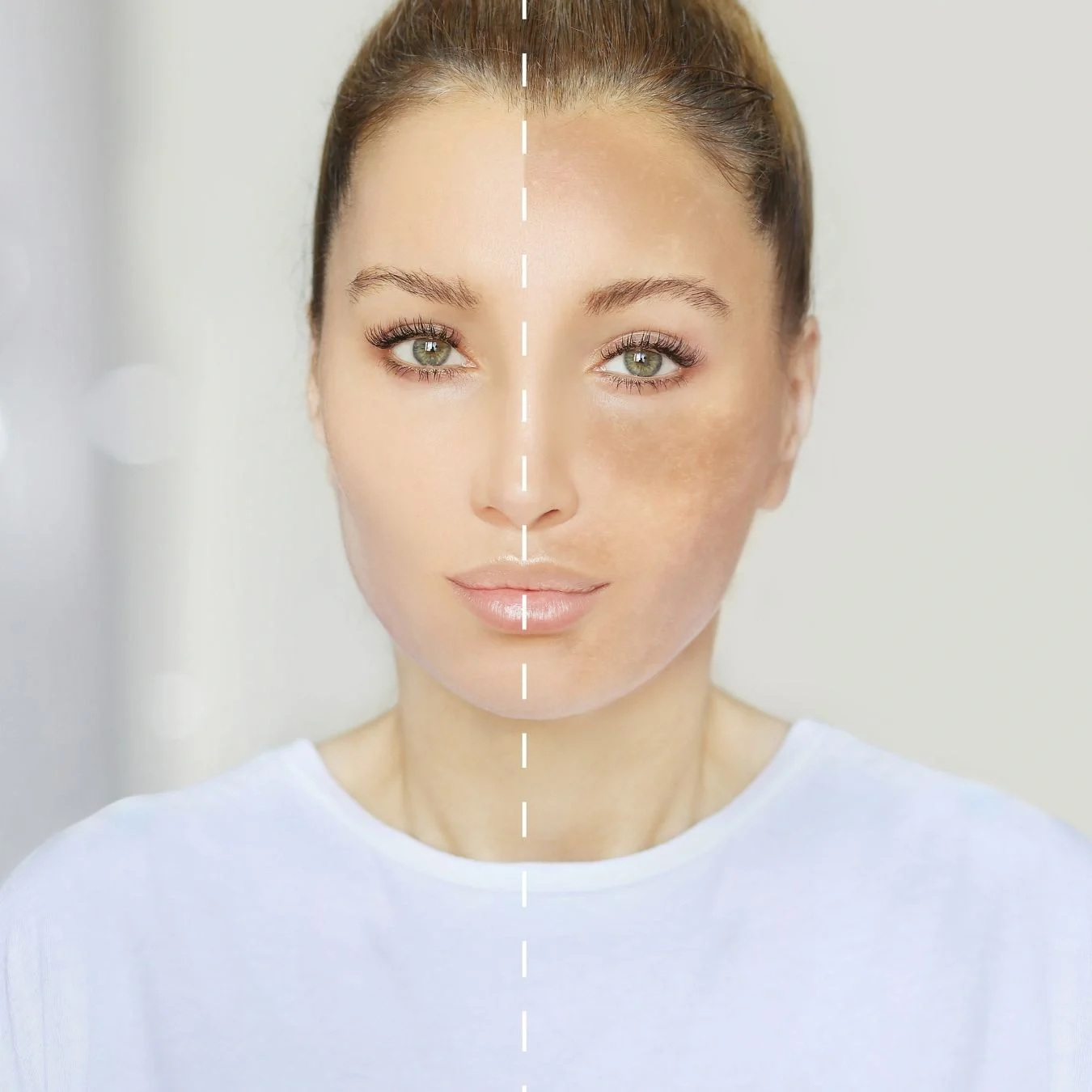 Results of Hyperigmentation Face Treatment