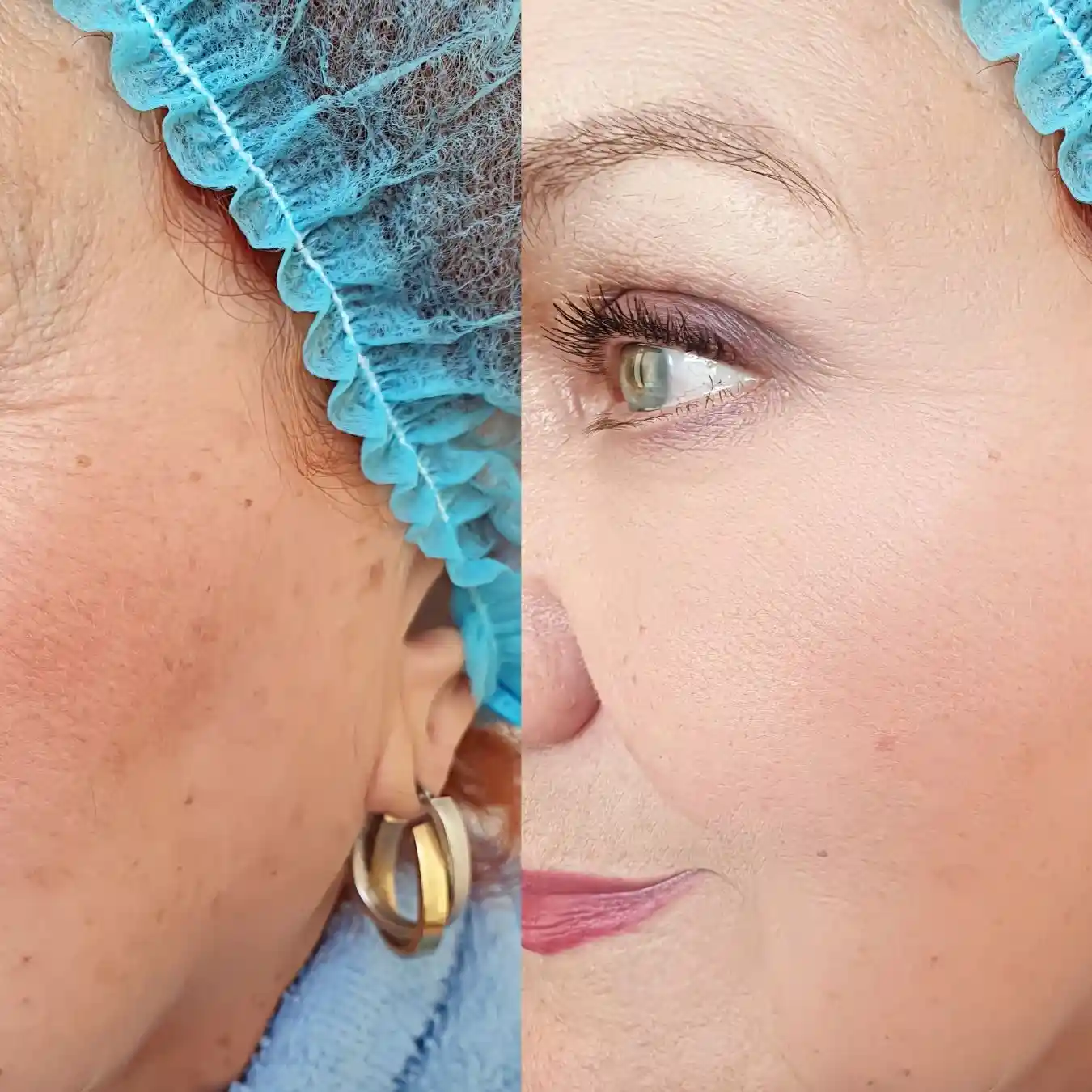 Fractional CO₂ Laser Before and After