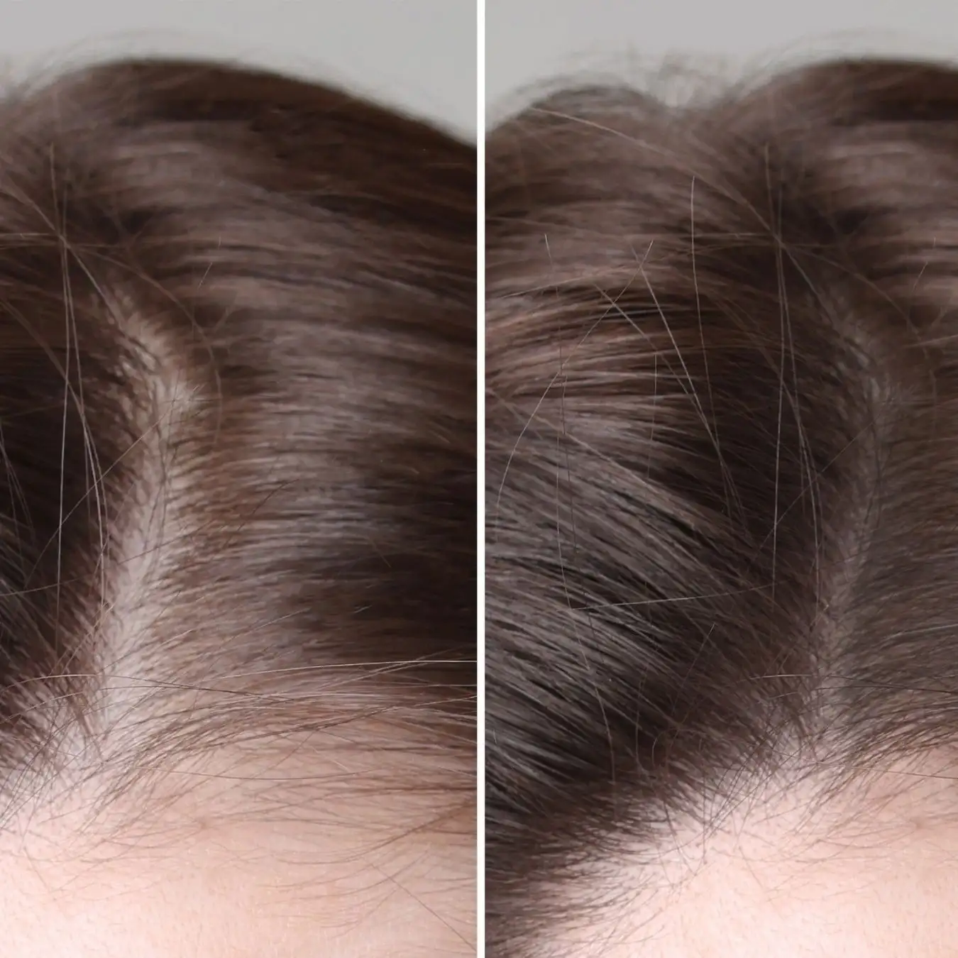 Female Hair Transplant Before and After