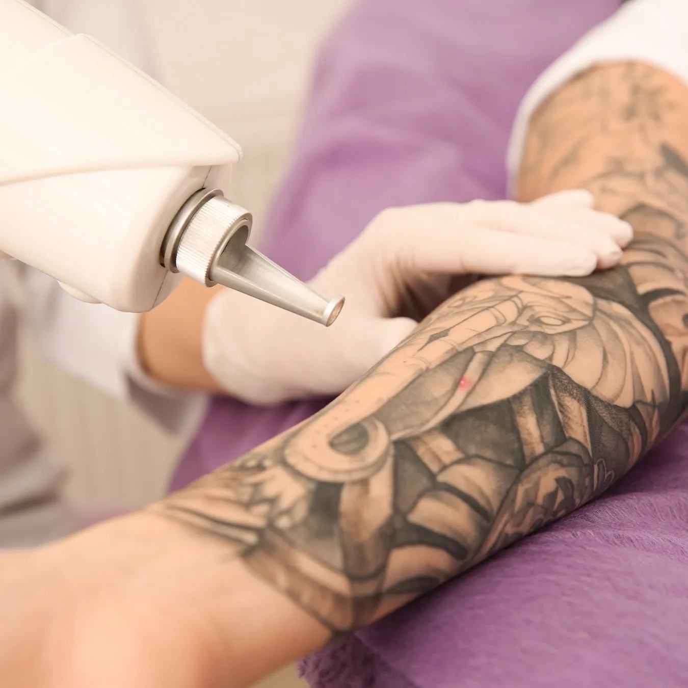 Laser Tattoo Removal Before and After