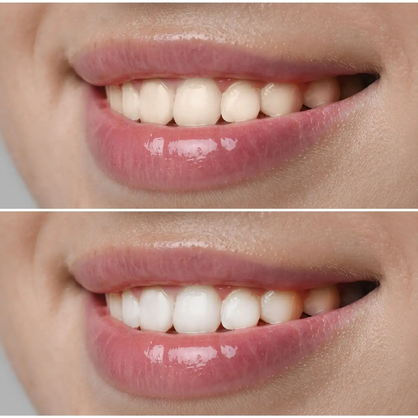 Restylane Filler Before and After