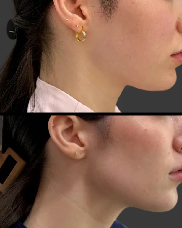 Jawline Filler Before and After in Islamabad