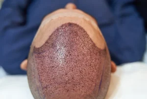 Hair Transplant Cost in Islamabad | Restore Skin