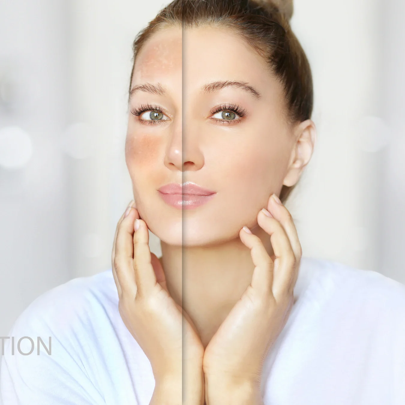 Melasma Before and After Results in Islamabad