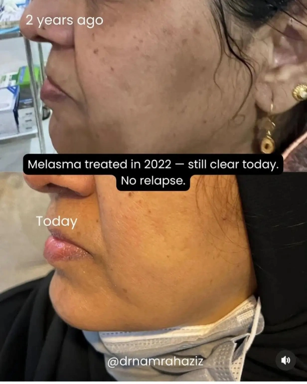 customized melasma before and after treatment