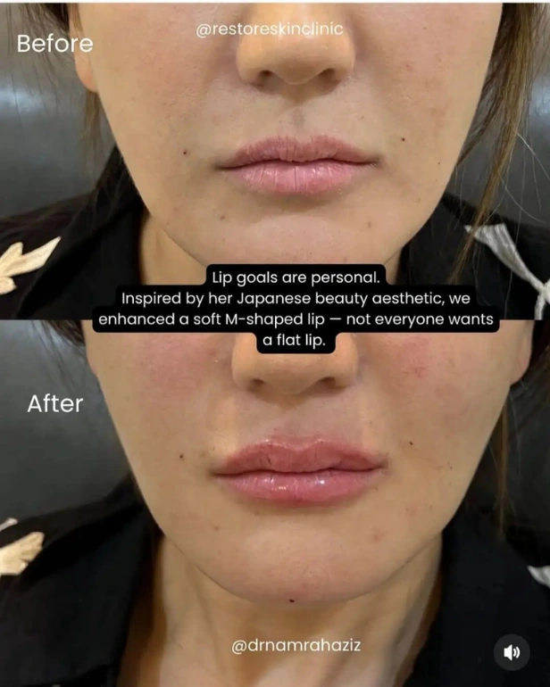 lip fillers before and after