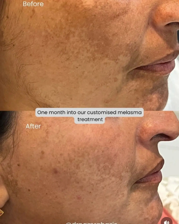 melasma treatment before and after