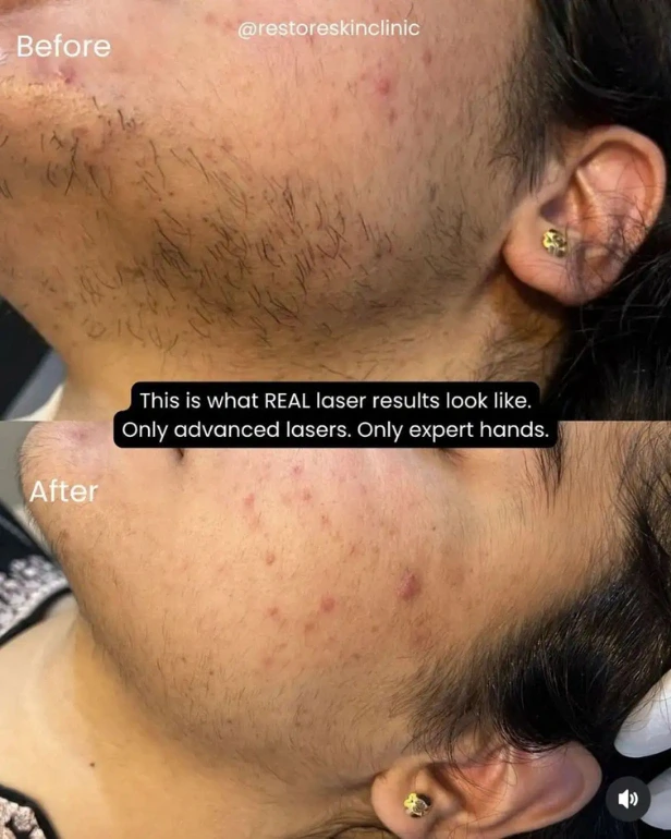 Dermatology Treatments Before and After