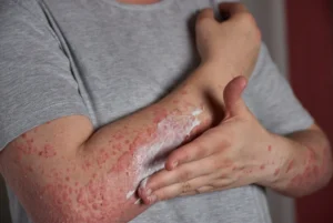 How to Cure Psoriasis Permanently Facts & Treatment Guide